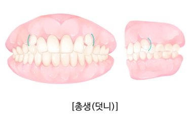 덧니 교정, 꼭 해야 할까? 미루면 안 되는 이유 | 안영민 원장