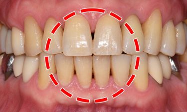 이 사이에 갑자기 생긴 검은 틈, 블랙 트라이앵글은 왜 생길까? | 김은경 원장