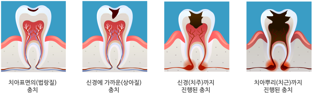 충치의 진행단계 일러스트