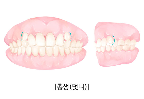 덧니(총생) 부정교합을 설명하는 치아교정 일러스트