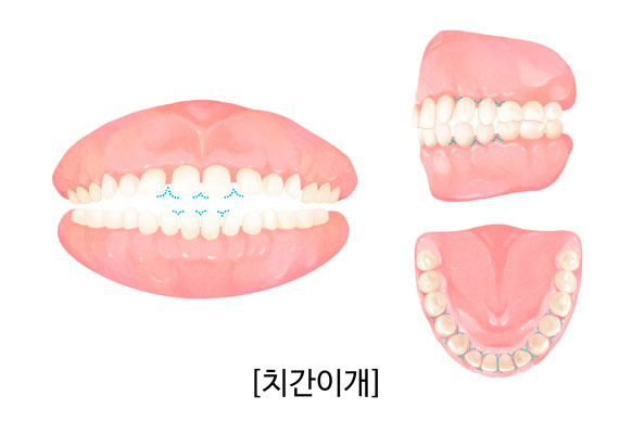 치간이개(치아 사이 벌어짐) 부정교합을 설명하는 치아교정 일러스트