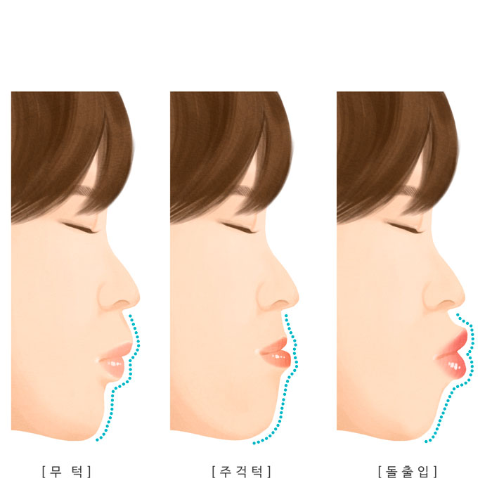 무턱, 주걱턱, 돌출입 등 턱뼈 문제로 전체교정이 필요한 유형을 보여주는 일러스트