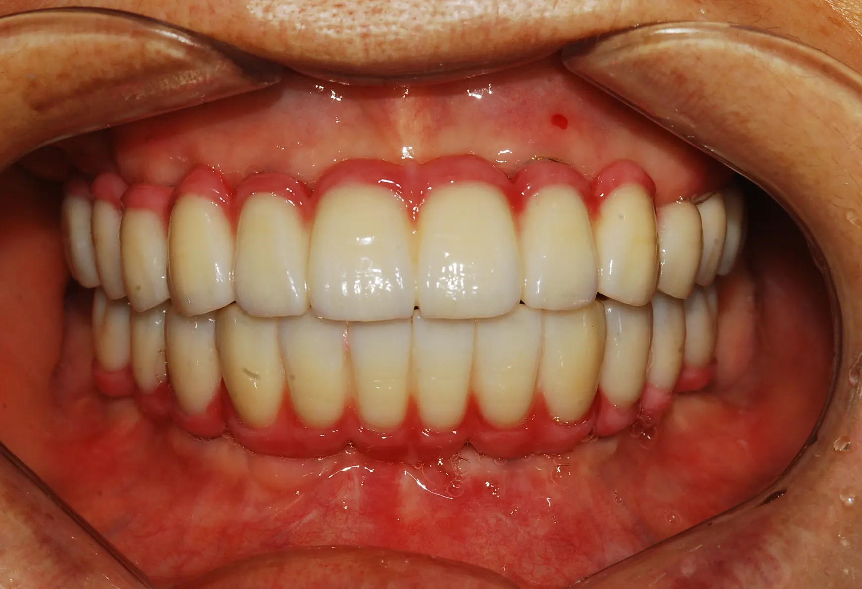 Dental implant case 01, after treatment