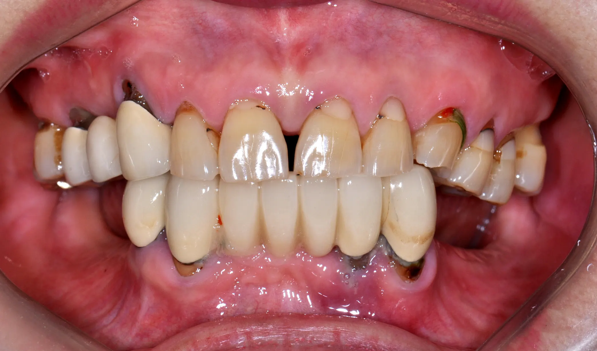 Dental implant case 01, before treatment