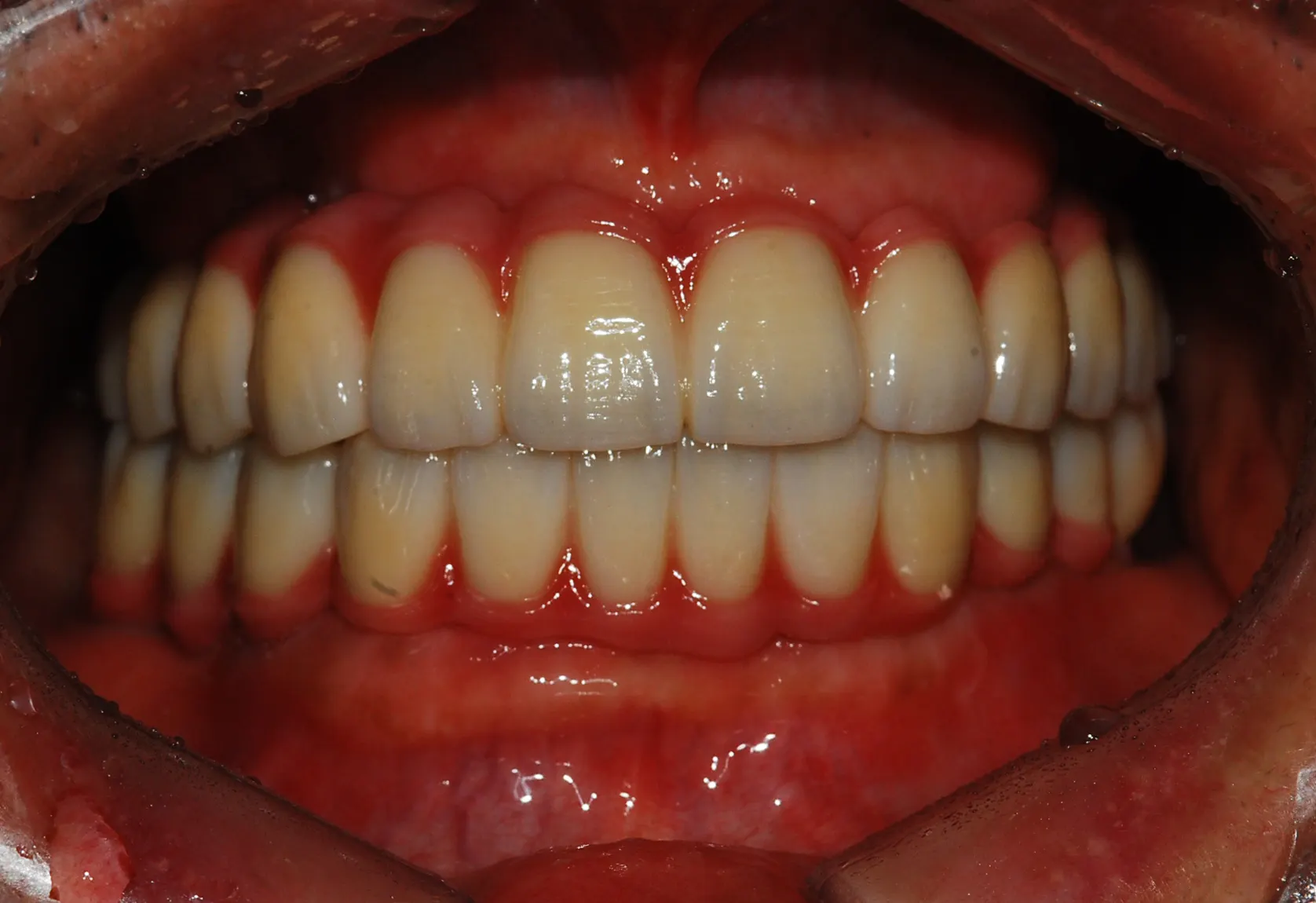Dental implant case 02, after treatment