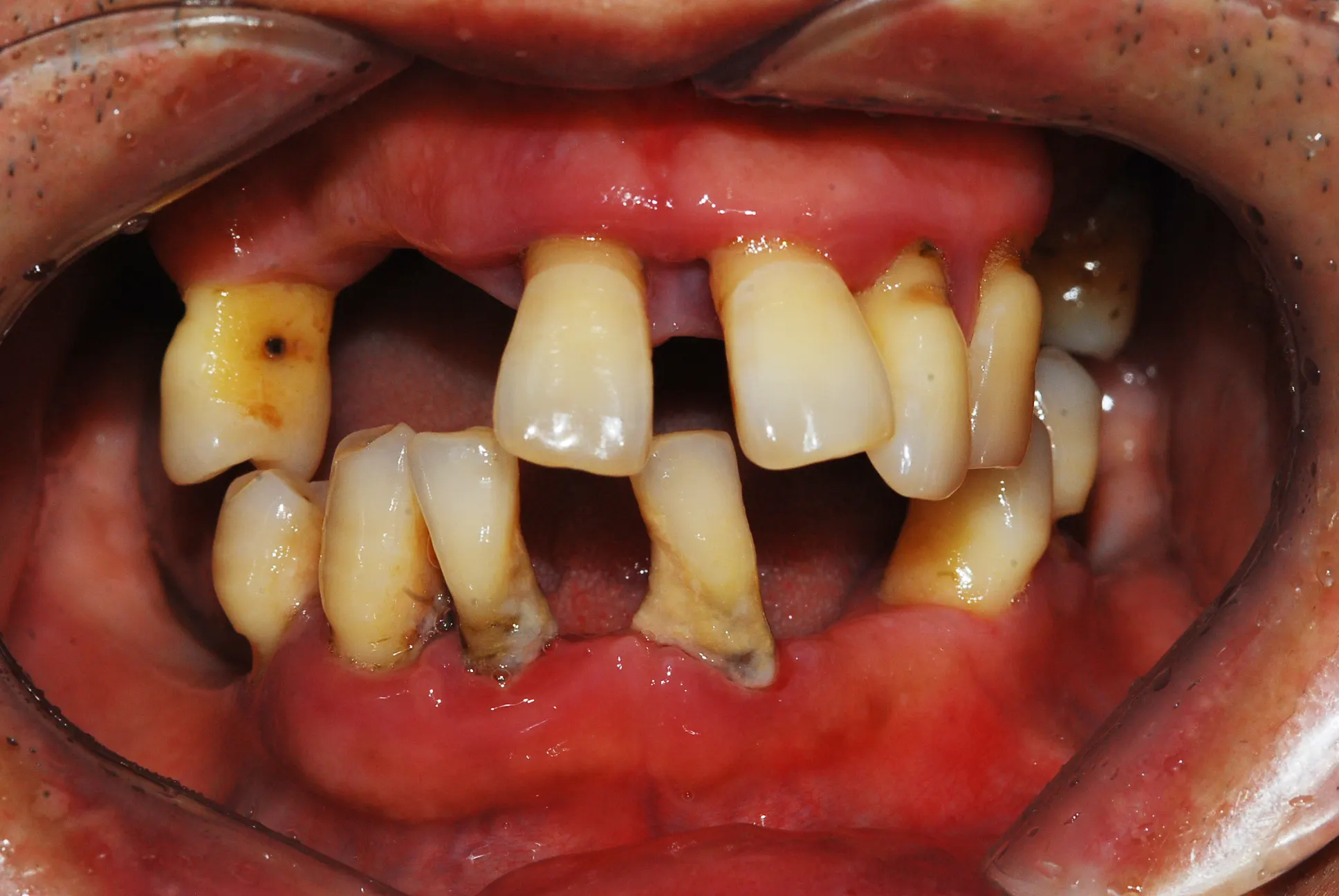 Dental implant case 02, before treatment