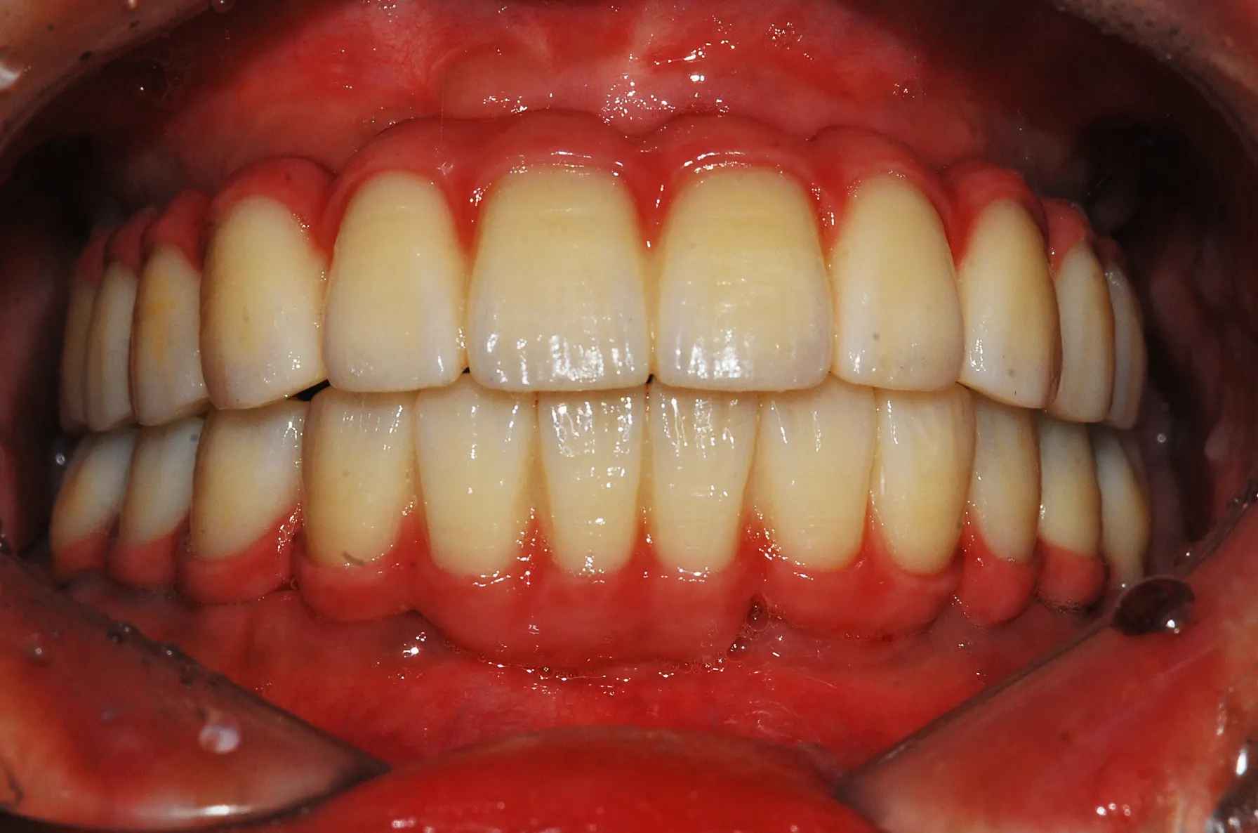 Dental implant case 03, after treatment