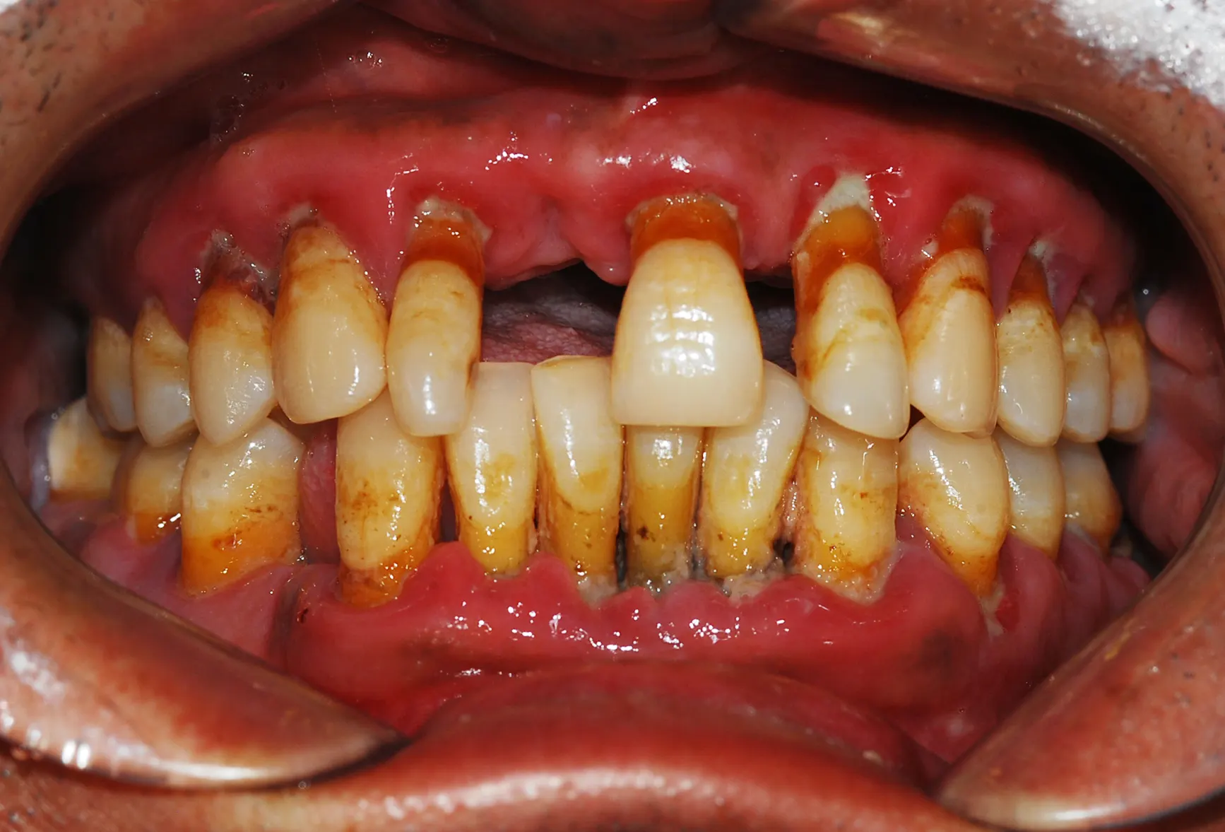 Dental implant case 03, before treatment