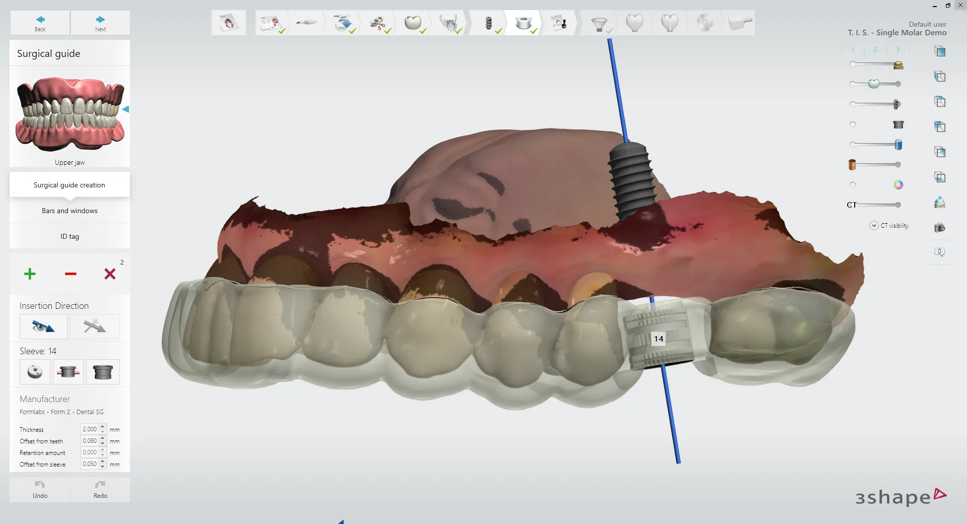 3Shape Implant Studio surgical guide planning