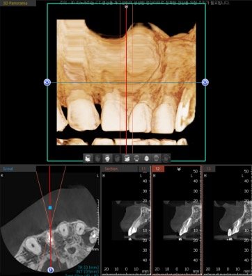 3D CT 임플란트 정밀 진단 화면 — 잇몸뼈 두께·신경관 위치 분석
